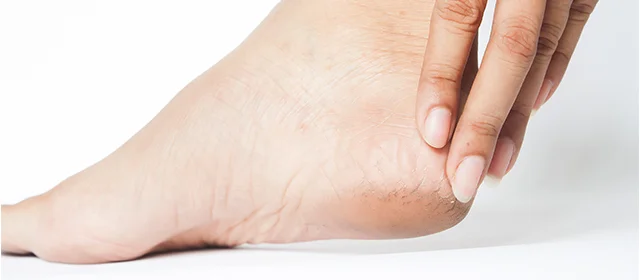 Ayak ve Topuk Problemleri (Topuk Dikeni, Plantar Fasiit)